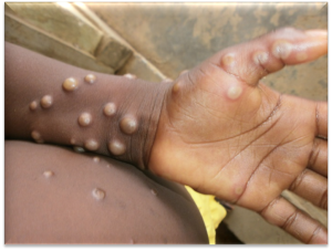 Edo Government Reports Eight Monkeypox Cases, Urges Residents to Observe Safety Measures