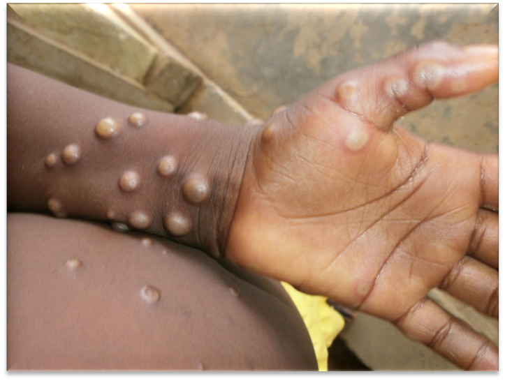 Edo Government Reports Eight Monkeypox Cases, Urges Residents to Observe Safety Measures